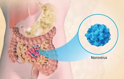 Норовирус в США: вспышка желудочно-кишечной инфекции