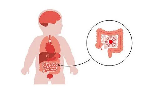 Норовирус в США: вспышка желудочно-кишечной инфекции