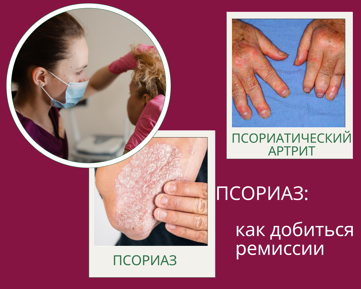 фейза дживелек парик псориаз