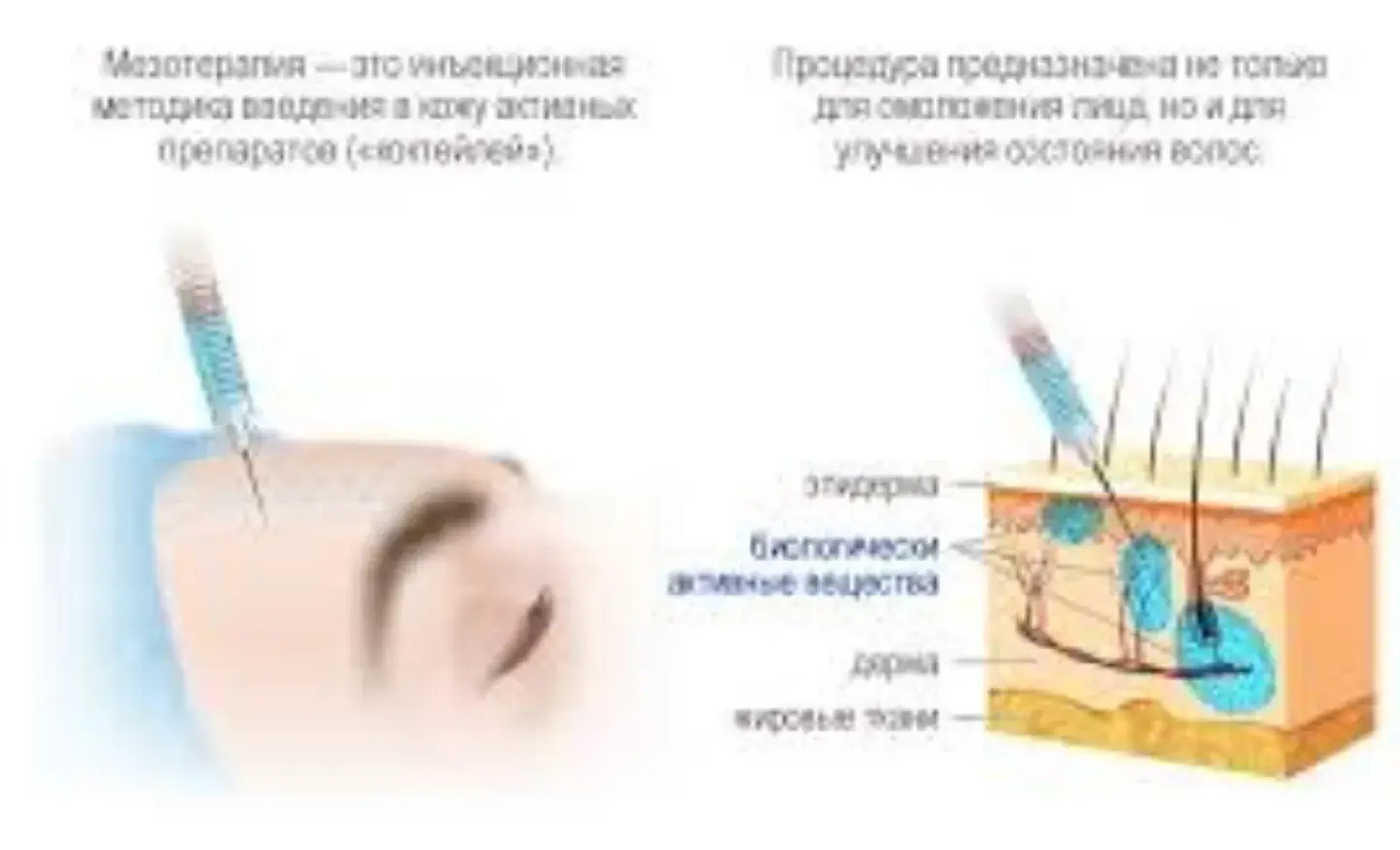 аюрведические инъекции мезотерапия растительные экстракты