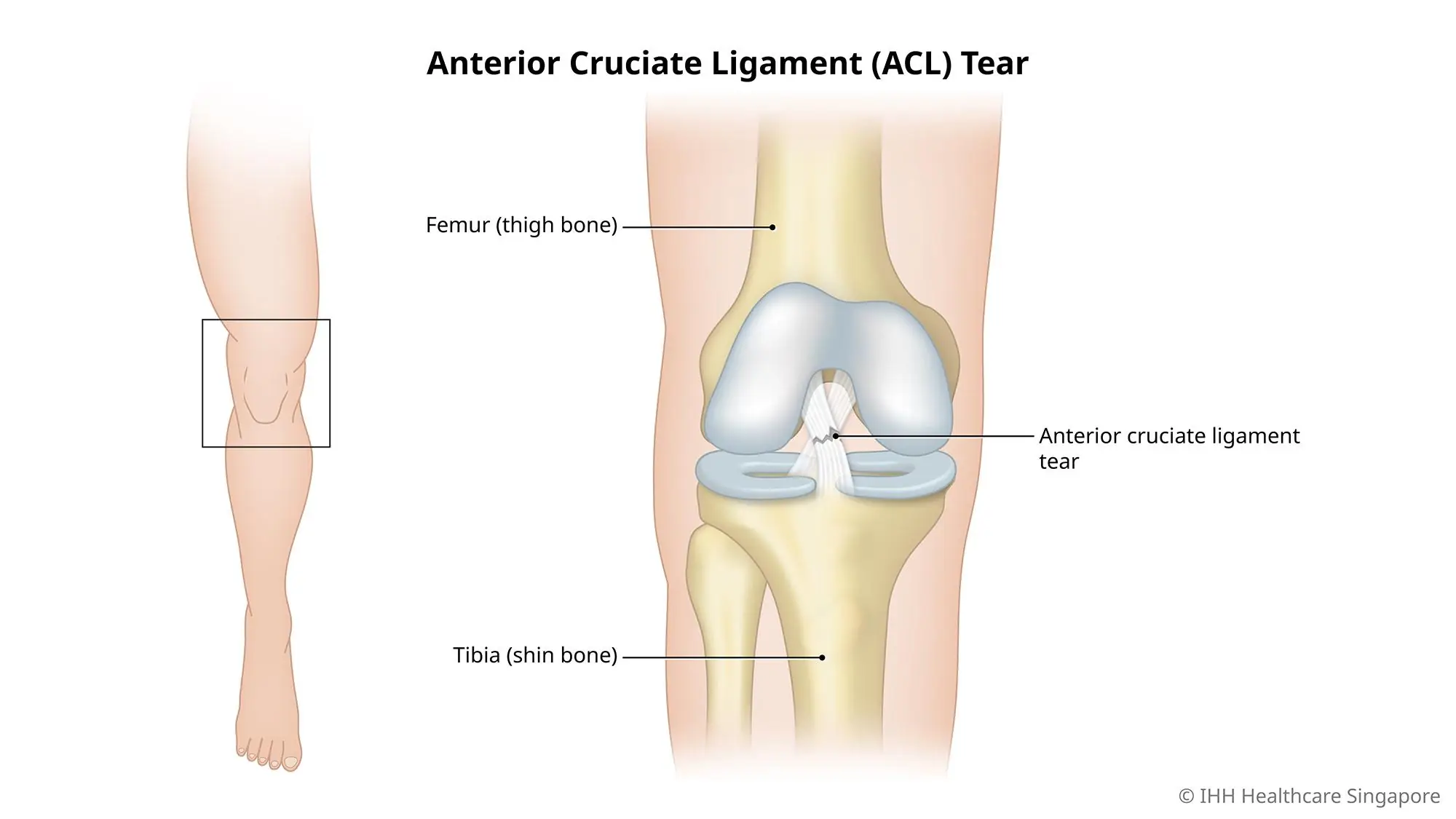 Knee anatomy ACL tear medical illustration