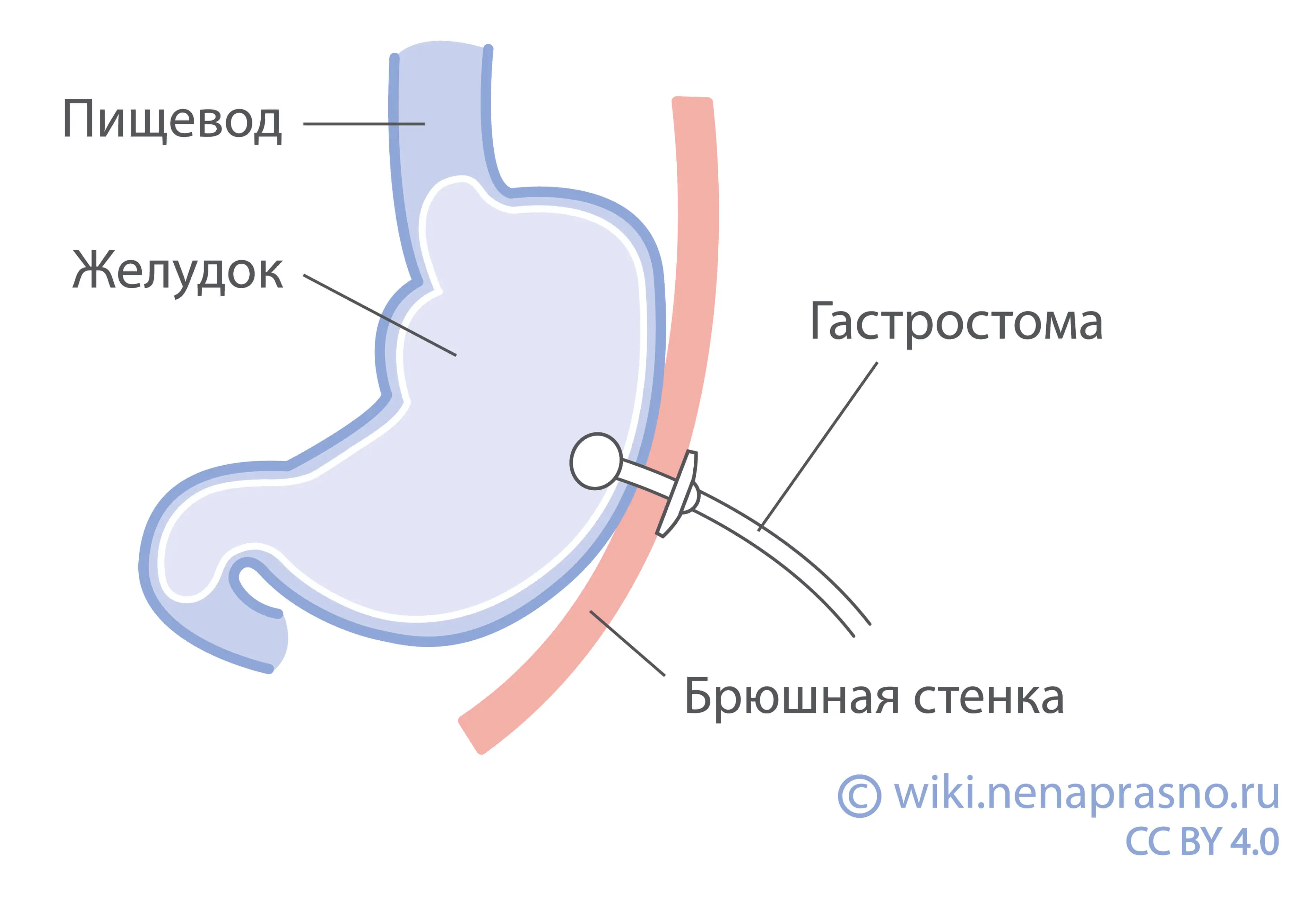 гастростома у детей установка