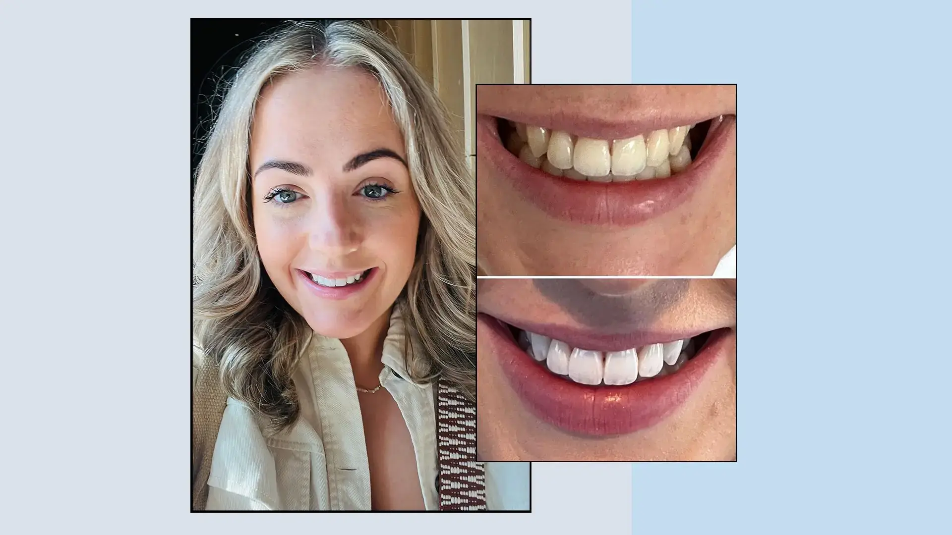 beauty blogger teeth transformation