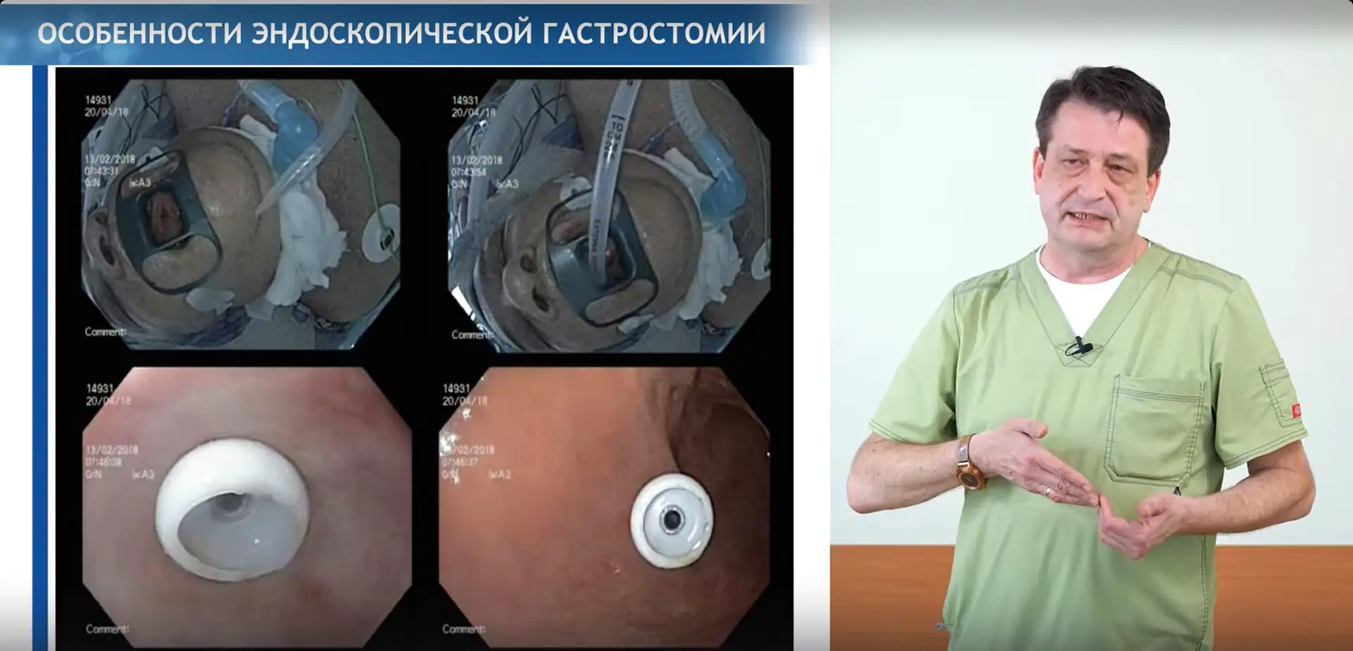 Родители, проверьте кухню: 11-летняя школьница из Приморья потеряла 15 кг и получила гастростому из-за глотка щелочи из