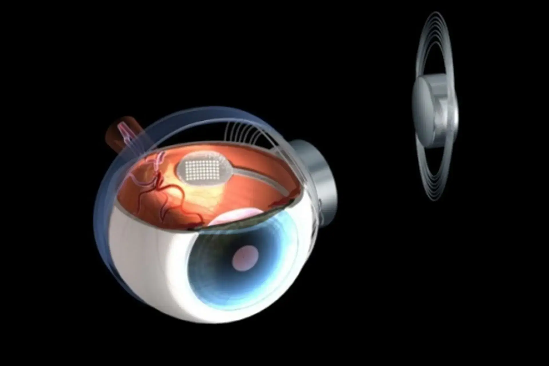 bionic eye implant technology real world prototype
