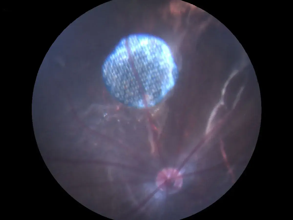 retinal implant medical device close up